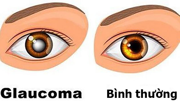 Bệnh glaucoma