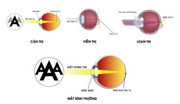 Tật khúc xạ ở mắt